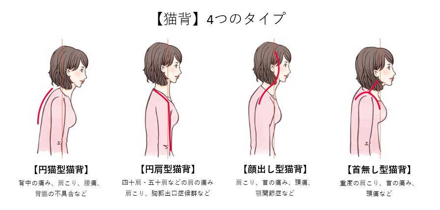 猫背4つのタイプ